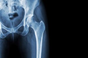 California Hip Replacement Lawyer
