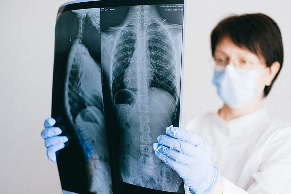 Doctor looking at lung xrays